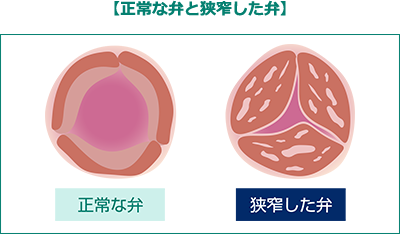 正常な弁と狭窄した弁